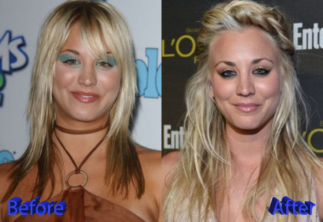 Kaley Cuoco Plastic Surgery An Example To Follow