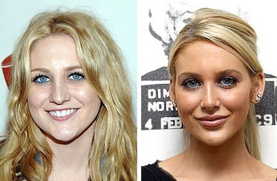 Stephanie Pratt before and after plastic surgery.