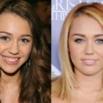 Miley Cyrus before and after cosmetic dentistry surgery