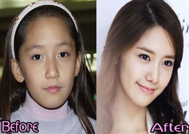 Yoona After Nose Job Plastic Surgery