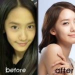 Yoona before and after nose job plastic surgery