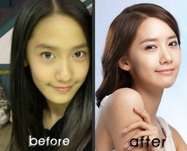 Yoona After Nose Job Plastic Surgery