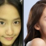 Yoona plastic surgery