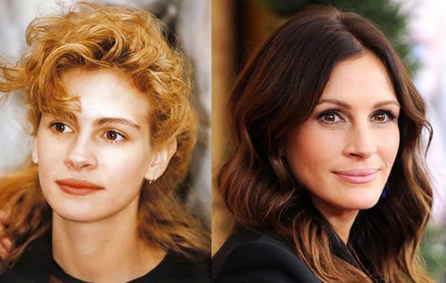 Julia Roberts Plastic Surgery Before and After