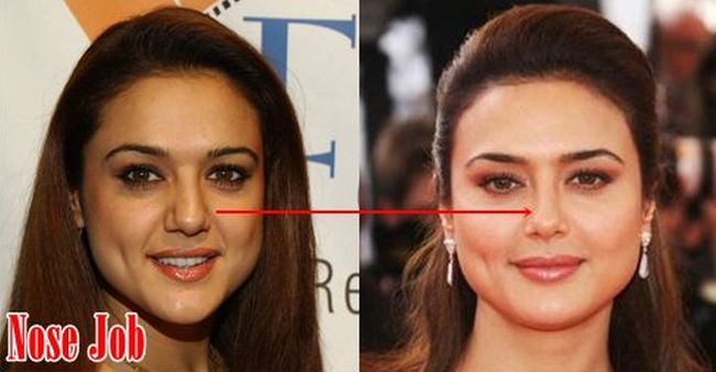Preity Zinta nose job before and after