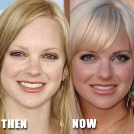 Anna Faris Plastic Surgery