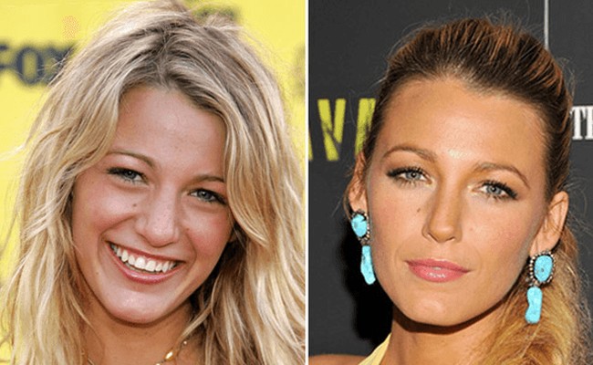 Blake Lively Nose Job Plastic Surgery before and after