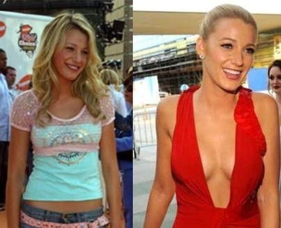 Blake Lively Before And After 