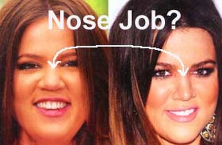 Khloe Kardashian nose job before and after