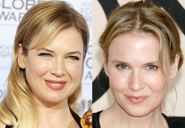 What Experts And Others Have to Say About Renee Zellweger Plastic Surgery?