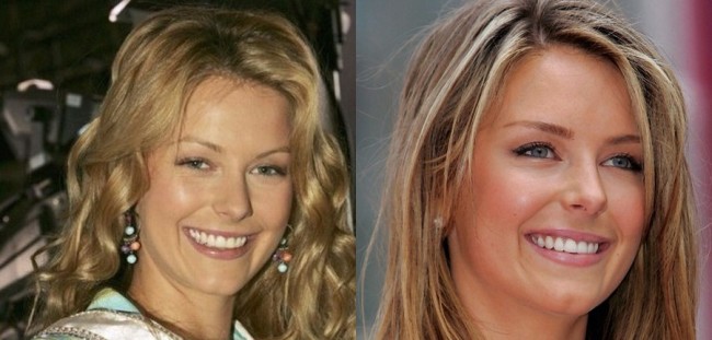 Jennifer Hawkins Before And After Plastic Surgery