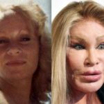 Catwoman plastic surgery before and after