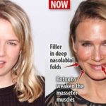 Renee Zellweger plastic surgery procedures