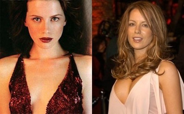 Kate Beckinsale Before And After Plastic Surgery