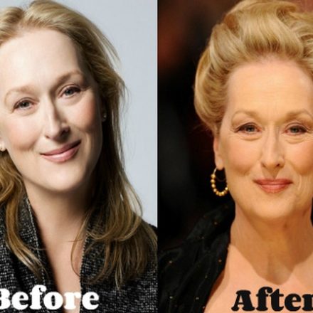 Meryl Streep Plastic Surgery: Could It Be?