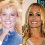 Taylor Armstrong before and after plastic surgery