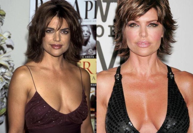 Lisa Rinna Breast Implants Before and After pictures
