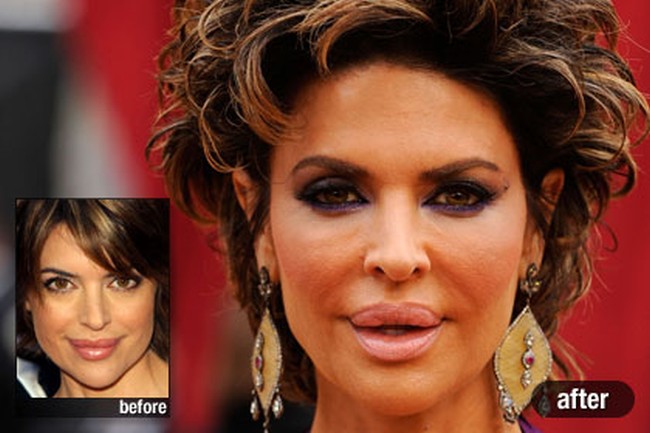 Lisa Rinna before and after lip fillers