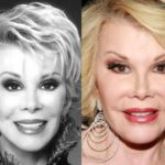 Joan Rivers Before And After Plastic Surgery