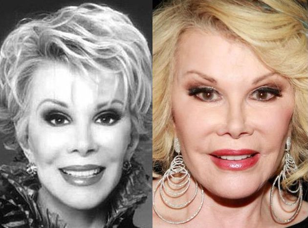 Joan Rivers Before And After Plastic Surgery