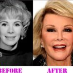 Joan Rivers Nose Job Before And After