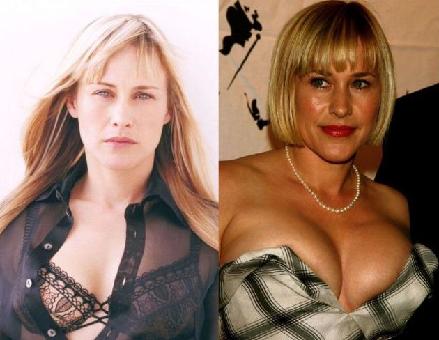 Patricia Arquette Before And After Plastic Surgery