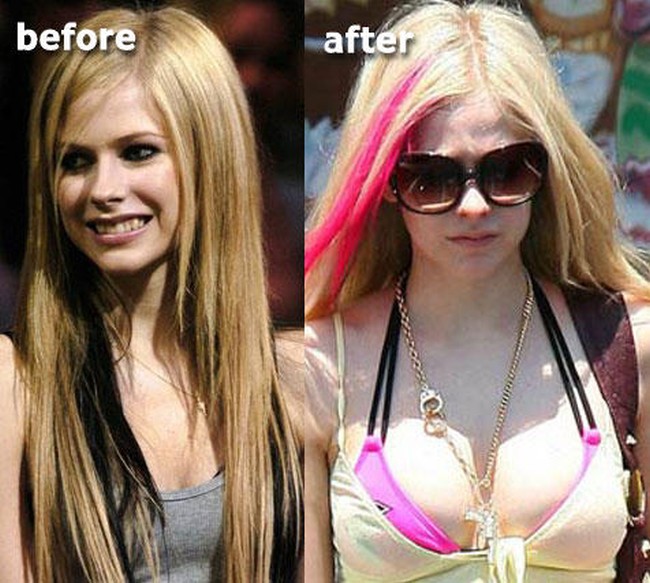 Avril Lavigne Breast Implants Plastic Surgery