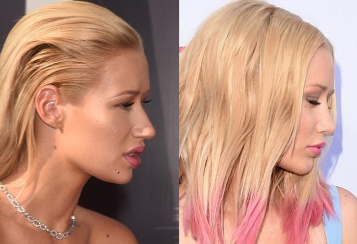 Iggy Azalea before and after nose job plastic surgery