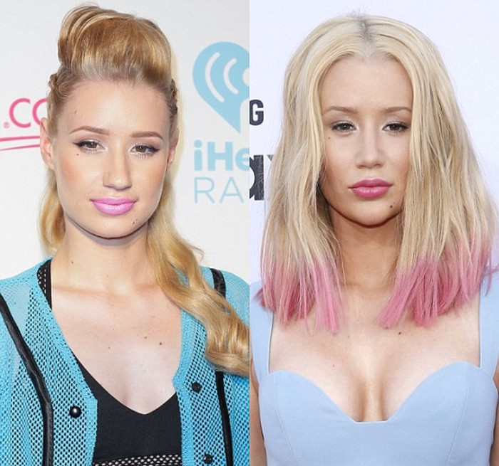 Iggy Azalea breast implants before and after