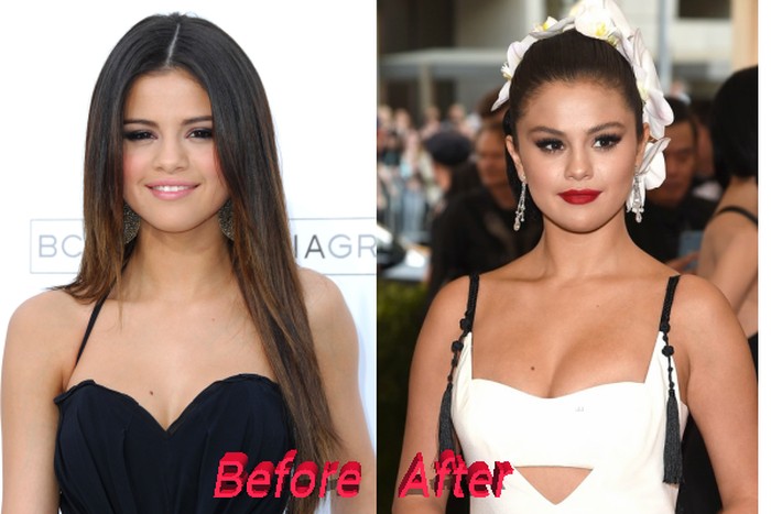 Selena Gomez before and after breast augmentation and nose job