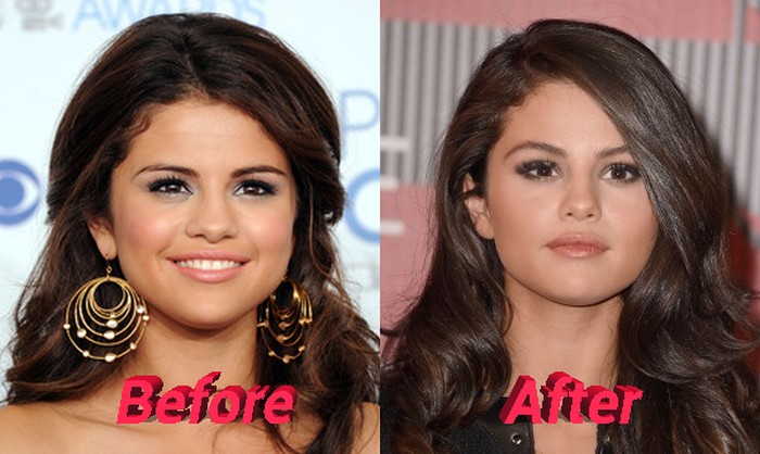 Selena Gomez nose job before and after