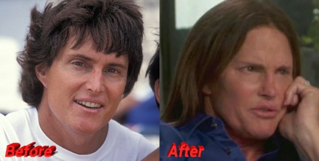 Bruce Jenner Plastic Surgery From Male Athlete To Female Star