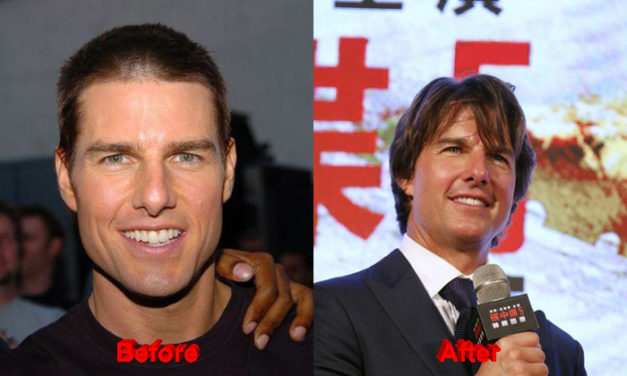Has Tom Cruise undergone Plastic Surgery?
