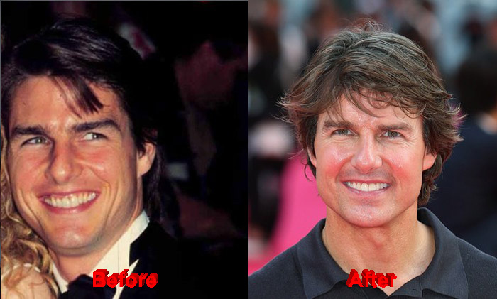 Tom Cruise before and after teeth