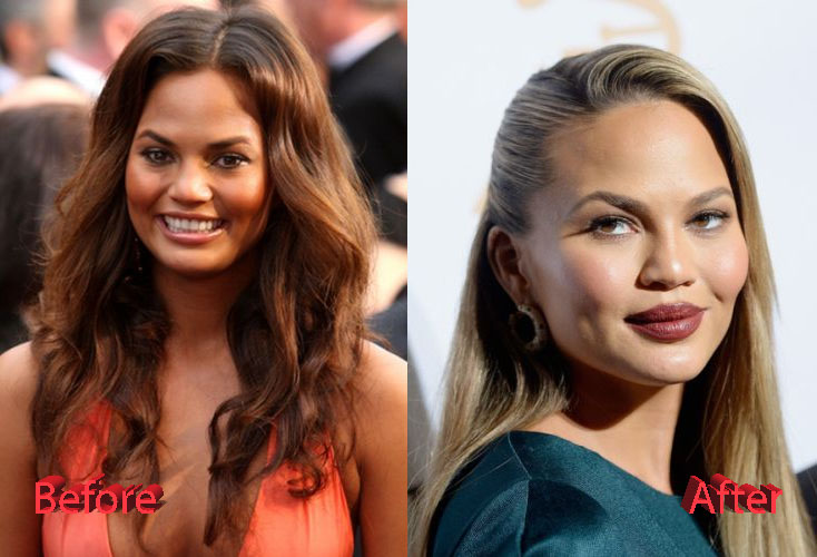 Chrissy Teigen Plastic Surgery: Just Speculations?