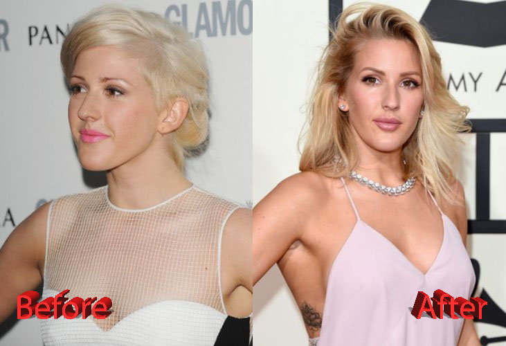 Ellie Goulding Plastic Surgery Before and After