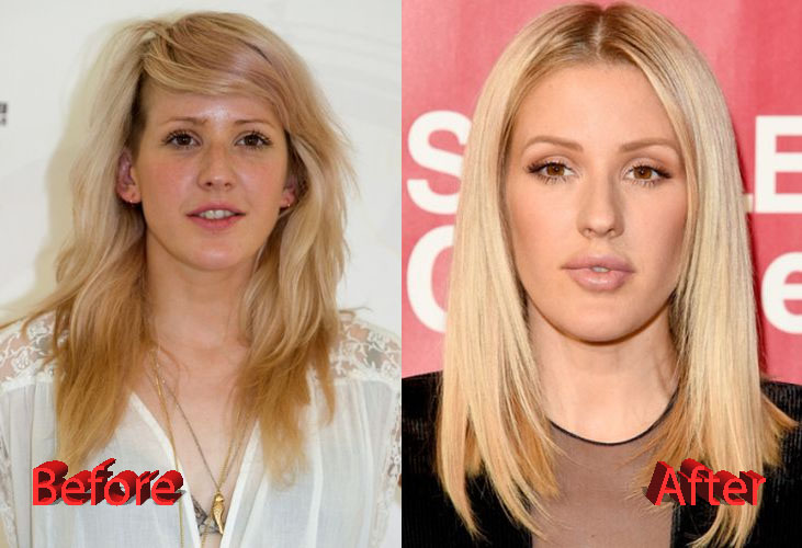 Ellie Goulding Plastic Surgery Before and After2
