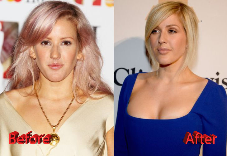 Ellie Goulding Plastic Surgery Before and After3