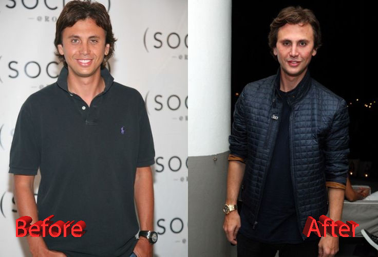 Jonathan Cheban Plastic Surgery Before and After2