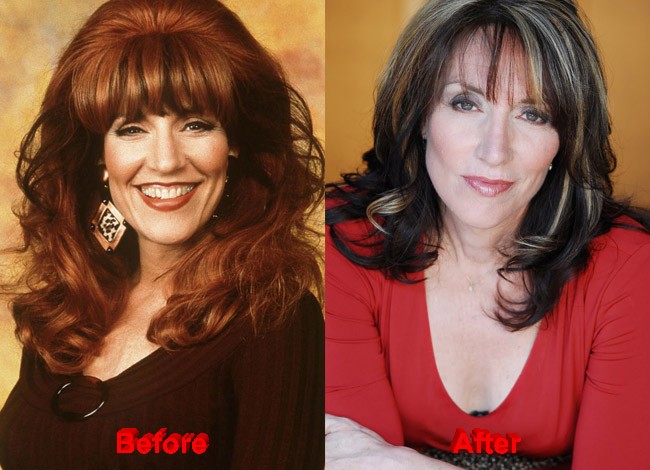 Katey Sagal Plastic Surgery botox