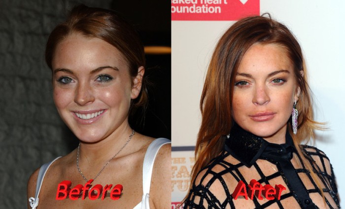 lindsay lohan before and after plastic surgery