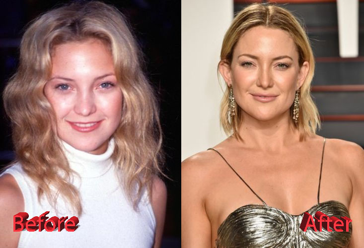 Kate Hudson Plastic Surgery Before and After