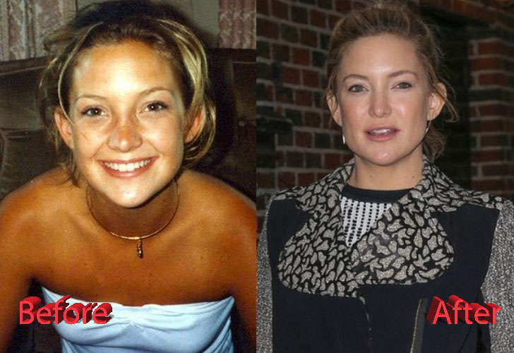 Kate Hudson Plastic Surgery Before and After3.