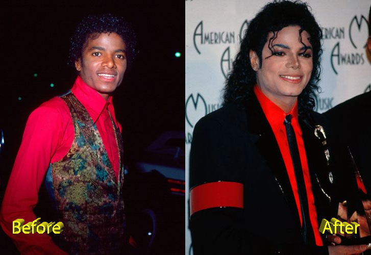 Michael Jackson Plastic Surgery Before and After
