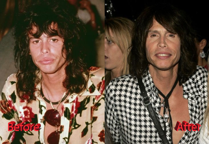 Steven Tyler Before and After Cosmetic Surgery