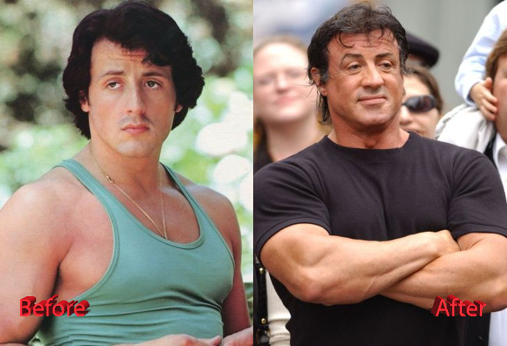 Sylvester Stallone Before and After Cosmetic Procedure