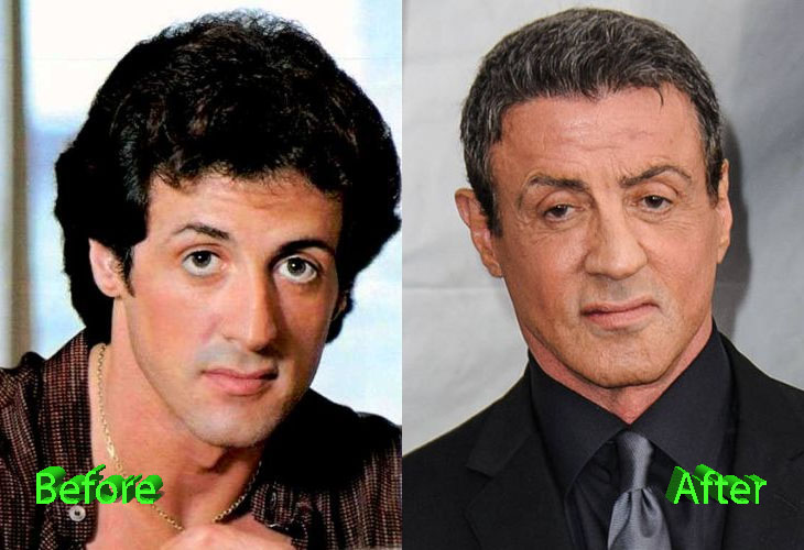 Sylvester Stallone Plastic Surgery Before and After