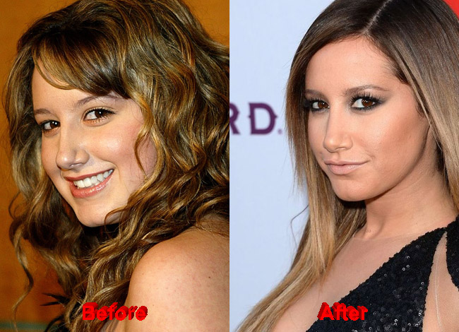 Ashely Tisdale Plastic Surgery before after nose job