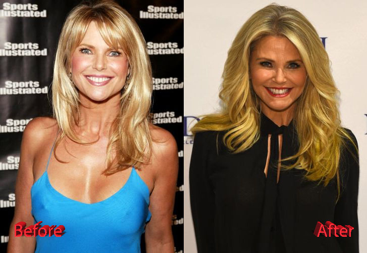 Christie Brinkley Before and After Cosmetic Surgery
