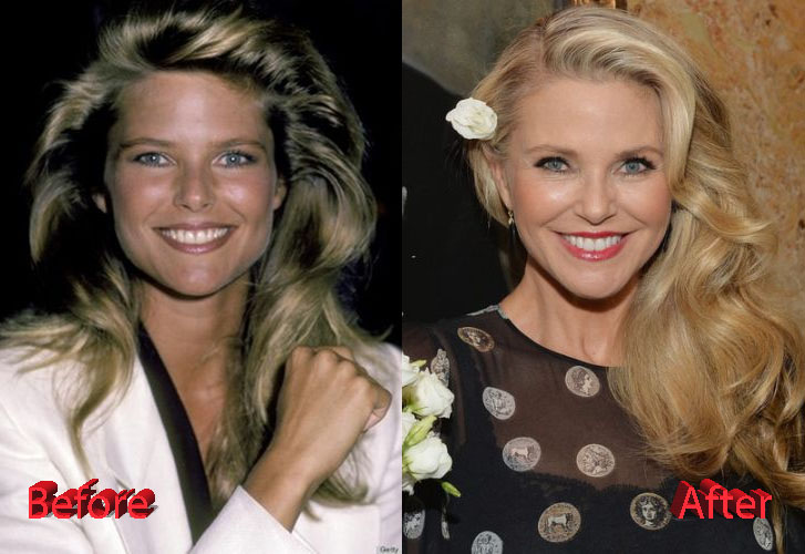 Christie Brinkley Cosmetic Procedure Before and After
